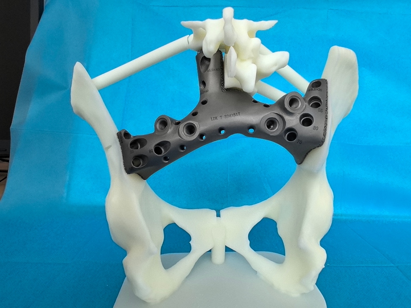 術(shù)前模擬的3D打印腫瘤假體。